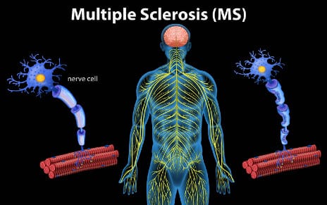 MS Progression is Apparently Slowing, Thanks to Medical Advances